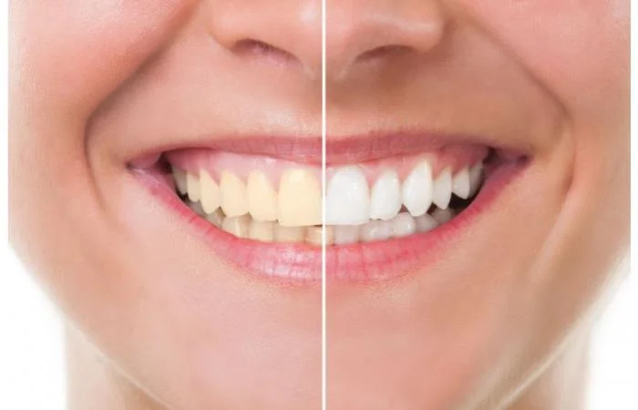 افضل طرق تبيض الاسنان من مستحضرات الطبيعية لإزالة الجير والاصفرار نهائيا - موسوعة الشامل