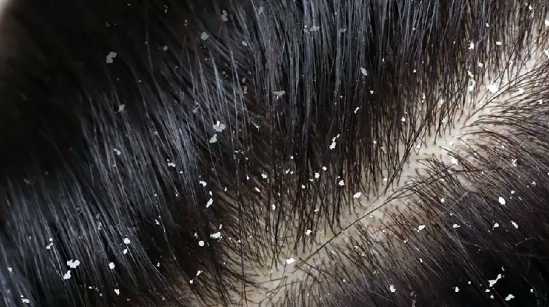 Interpretasi ngimpi babagan ketombe rambut ing ngimpi kanggo wong wadon sing pegatan - Ensiklopedia Al Shamel